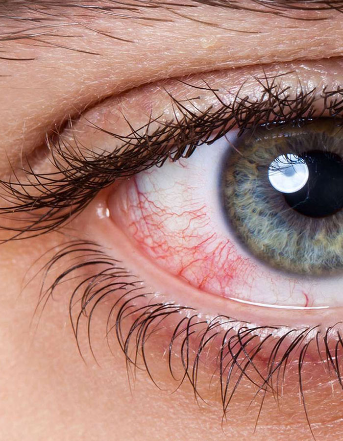 Les pathologies de l’œil