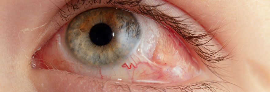 vitrectomie